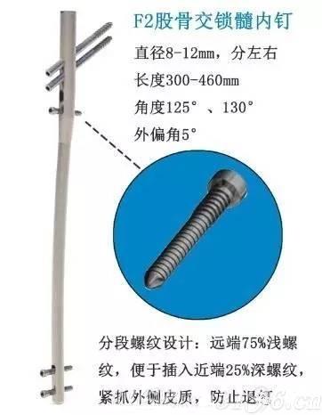 电子导航髓内钉股骨髓内钉f2股骨粗隆下骨折